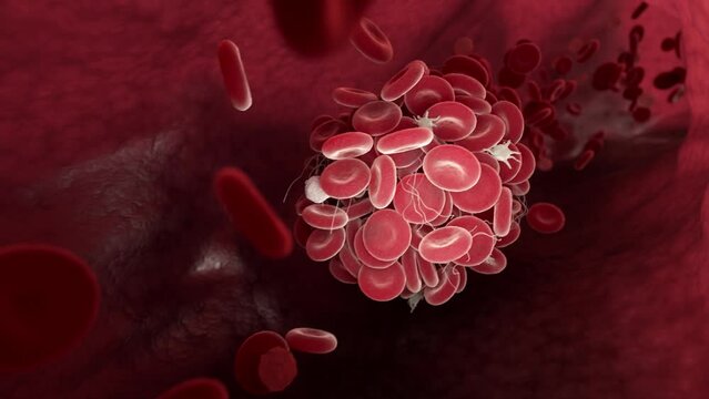 3D animation of a blood clot moving through a blood vessel.