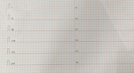 12 lead ECG showing Flat line which represents the stoppage of cardiac rhythm 