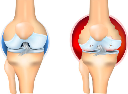 Rheumatoid Arthritis of knee joint