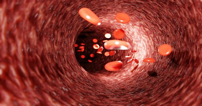 Fat clogs the arteries in the body. LDL. low-density lipoproteins.3d rendering. Chronic non-communicable diseases. Causes of heart disease. Sickness. Dangerous to health.