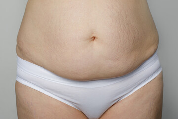 Female belly with striae after pregnancy and childbirth on white background