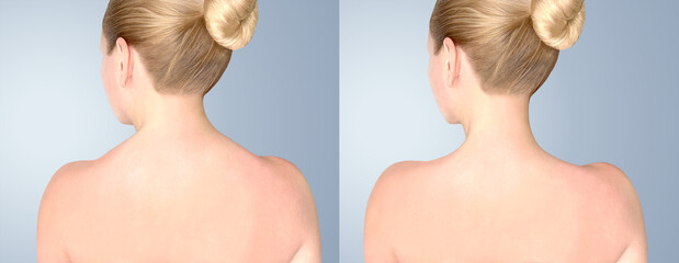 Botulinum toxin injection for trapezius muscle. Back of neck and shouledrs before and after botulinum toxin.