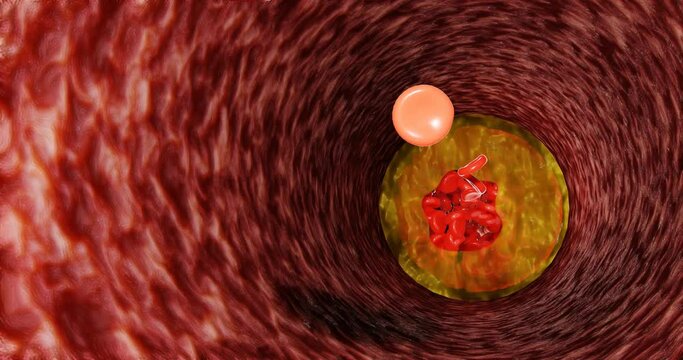 Fat clogs the arteries in the body. LDL. low-density lipoproteins.3d rendering. Chronic non-communicable diseases. Causes of heart disease. Sickness. Dangerous to health.	