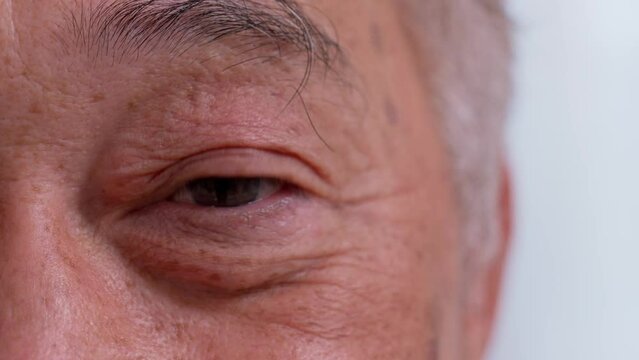 Close up of the senile cataract during eye examination. A white cloudy disc is seen in black eye circle, mature cataract, nuclear sclerosis cataract. Close up half face view