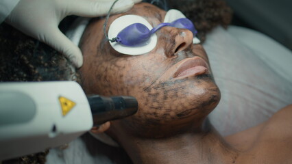 Closeup face peeling procedure with laser equipment. Cosmetician treating skin