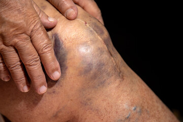 Close up of senior hand gently touching severely bruised knee, extensive bruising and injury skin...