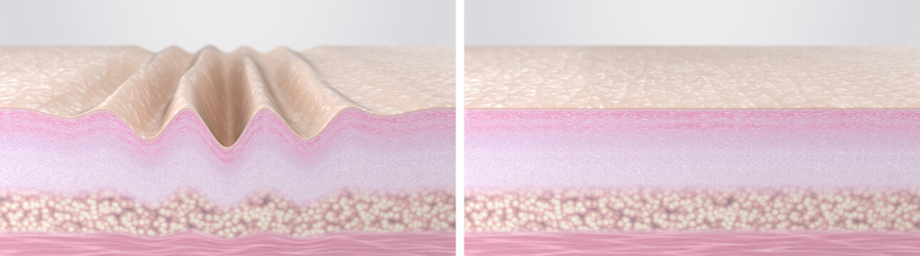 Wrinkled aged and young smooth skin comparison. 3d rendered illustration. Cross-section of skin tissues before and after hyaluronic acid injections, collagen peptides, laser therapy, EMS, RF facelift