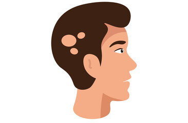 Alopecia areata is an autoimmune condition causing patchy hair loss on the scalp, face, and body. It occurs when the immune system attacks hair follicles, leading to sudden, vector