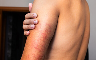 Red rash on the shoulder. atopic keratosis. allergy.Urticaria vasculitis. itchy wheals.  Angioedema. Sunburns.