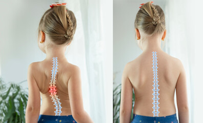 child, young girl showcasing Normal healthy spine and curved spine with scoliosis, need medical...