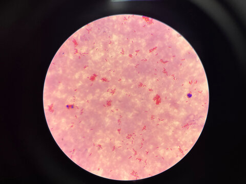 Moderate gram negtive bacilli in hemoculture.