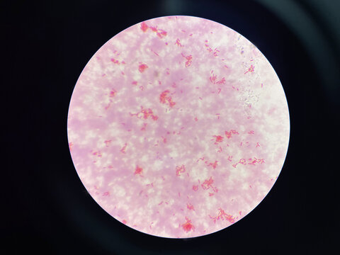Moderate gram negtive bacilli in hemoculture.