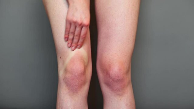 Leg pain, skin irritation concept. Close-up woman massaging red knees standing on gray background