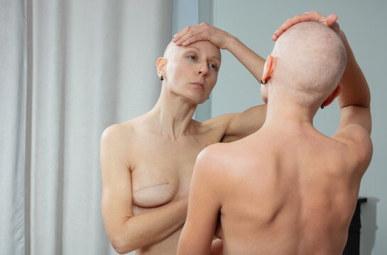 Hairless topless woman studies mastectomy scars in reflection