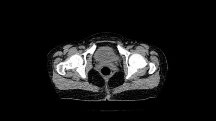 normal abdomen CT  scan 