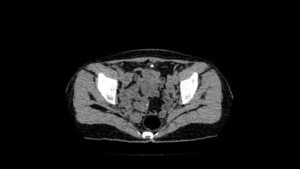 normal abdomen CT  scan 