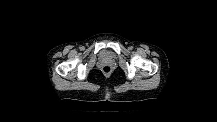 normal abdomen CT  scan 