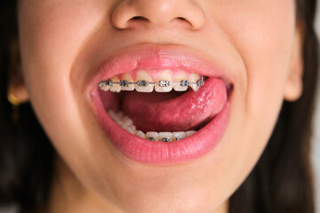Unrecognizable female teenager mouth with braces stick out her tongue.