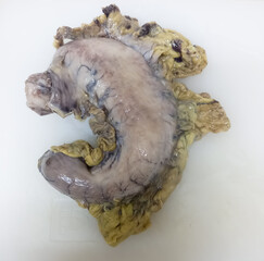 Resected whole stomach after operation at laboratory for biopsy. Gastric biopsies.