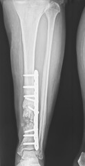 X-ray of the leg. Old spiral fracture at left lower tibia. Evidence of previous surgery with metallic fixators is in situ. Joint space and articular surfaces are unremarkable.