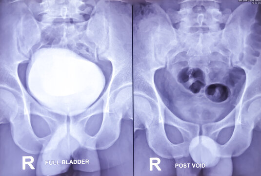 X-Ray film of RGU and MCU (Retrograde urethrogram and micturating cystogram). Radiological test that inject dye via urethra to identify urethral narrowing. Narrow stream of urine with significant PVR