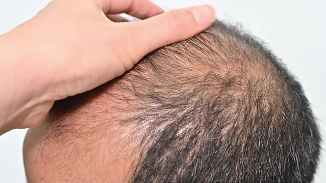 Someone hand touching Asian baldness man scalp for checking hair loss problem before Hair Transplantation.