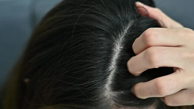 Close up of woman having itchy problem on her head cause of dandruff.