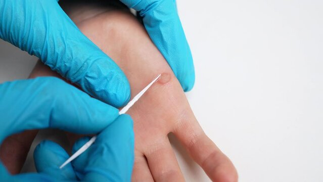 Doctor examines child hand with viral warts Verruca vulgaris, close-up, applies wart repellent using applicator to wart. Papillomavirus, HPV. Pediatric dermatology. Skin diseases. 
