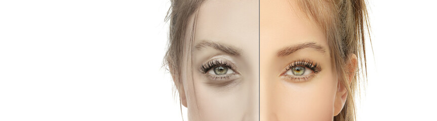 Lower and upper Blepharoplasty.plastic surgery concept.