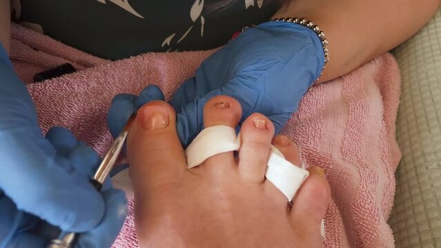 Beautician making onychomycosis pedicure treatment and nail reconstruction, health care 4k