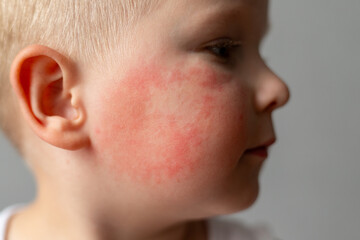 Small child with red rash on cheek