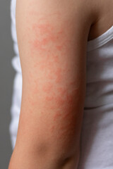 Child's arm with red rash