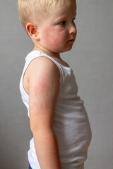 Child with rash on face and arms in white shirt