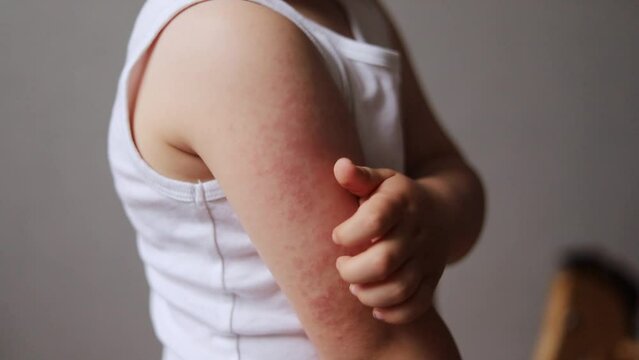 Child scratching arm with red rash