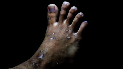 Close-up of feet with severe ulceration and dry wounds. Ideal for medical literature, healthcare presentations, or educational materials on skin conditions, diabetic foot care, and wound treatment.