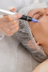 Peeling, woman health care, skin regeneration, dermapen microneedling, dermastamp. Beautician cosmetologist doing cheek face procedure fractional microneedle clinic mesotherapy. Facial rejuvenation