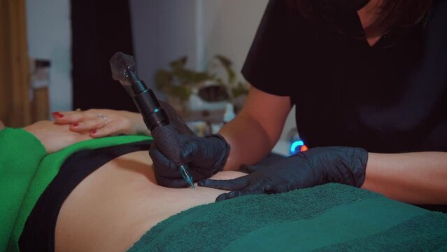 Stretch mark camouflage treatment, female doctor applies stretch mark tattooing process to hide stretch marks