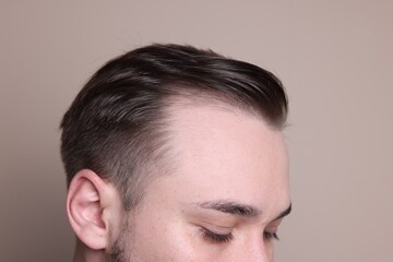 Obraz premium Baldness concept. Man with receding hairline on beige background, closeup