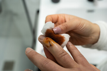 Anonymous woman carefully tending to post-tendon surgery finger with povidone iodine soaked gauze...