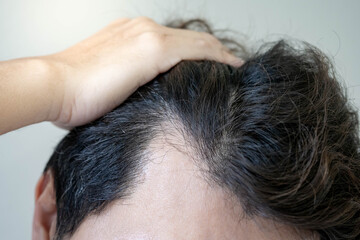 Hair loss or alopecia problem. Receding hairline. Closeup head of Asian man while raising up his...