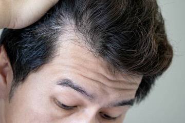 Obraz premium Hair loss or alopecia problem. Receding hairline. Closeup head of Asian man while raising up his black damaged hair showing bald head area and forehead creases wrinkle