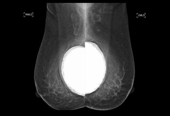 The mammogram BI-RADS 2-benign shows a breast implant augmentation with visible signs of capsular...