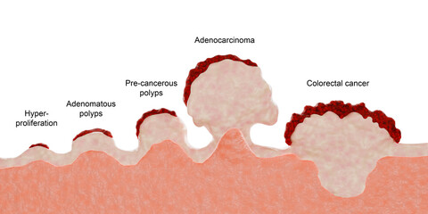 Colorectal cancer evolution. Hyperproliferation, adenomatous polyps and pre-cancerous polyps are benign. Adenocarcinoma and colorectal cancer are malign.