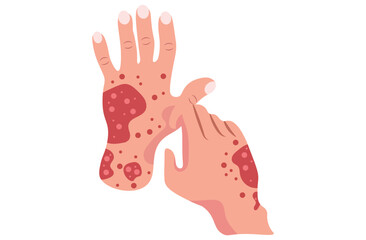 Autoimmune progesterone dermatitis,urticaria,Bullous pemphigoid,herpetiformis,Dermatomyositis,Epidermolysis bullosa acquisita,Gestational,Hidradenitis suppurativa,Lichen planus,Linear IgA,Pink