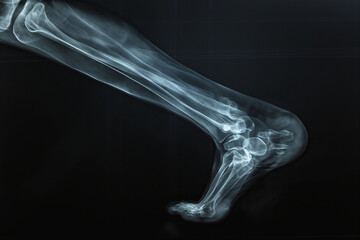 Leg skeleton anatomy x-ray view on dark background