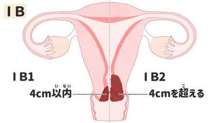 Cervical cancer stage 1B diagram PNG