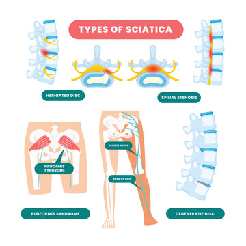 Different types of sciatica poster scheme, medical banner, Sciatica as symptom from herniated disc and spinal nerve diagram, nerve pain lower back through hips to leg, Labeled educational scheme.