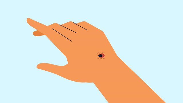 Hand and red insect tick bite animation. Tick in human hand biting with red area. 4K