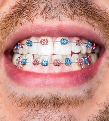 Closeup of a mans teeth with braces on. Metal braces system on the teeth. The concept of healthy...