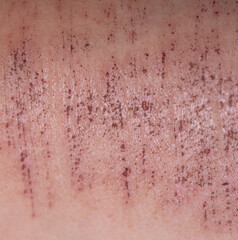 Wounds on the skin. Deep scratches on the skin. Wounds